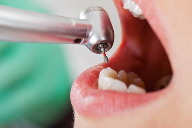 Best Emergency Dental Care for Abscessed Tooth in East Alton, IL